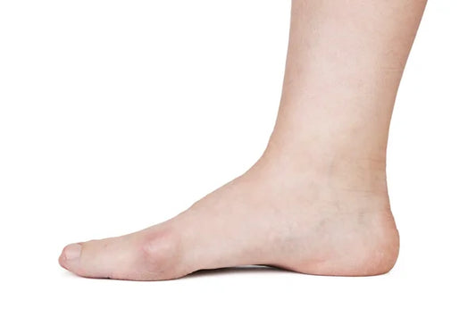 Top 5 Exercises for Flat Feet